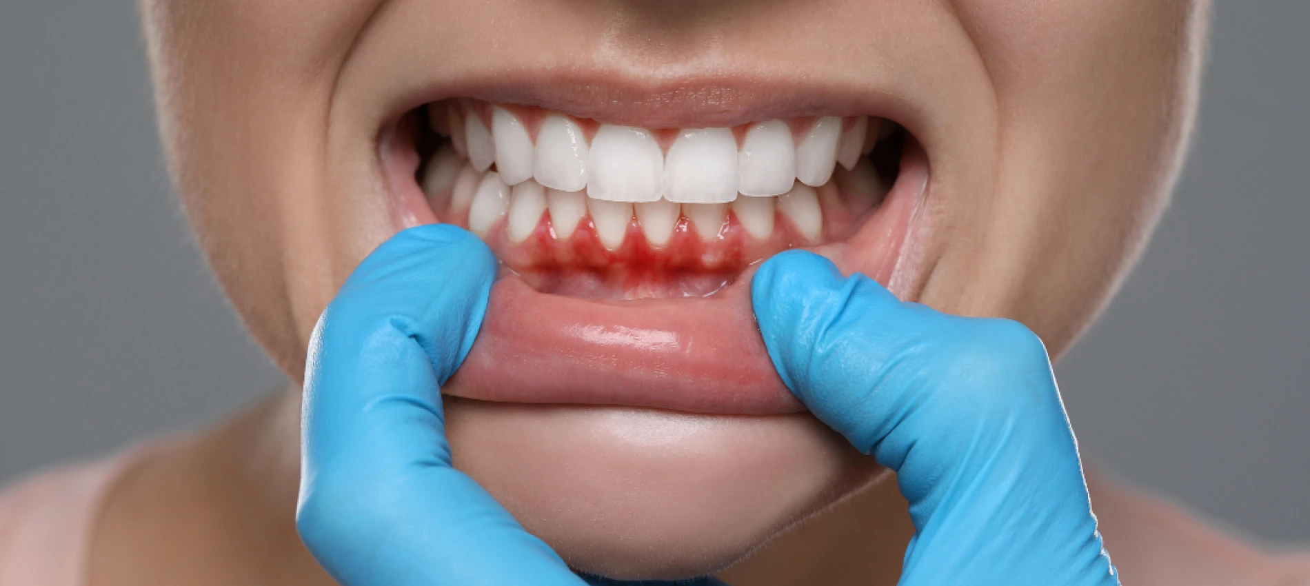 Gingii retrase? Cauze frecvente și opțiuni corecte de tratament