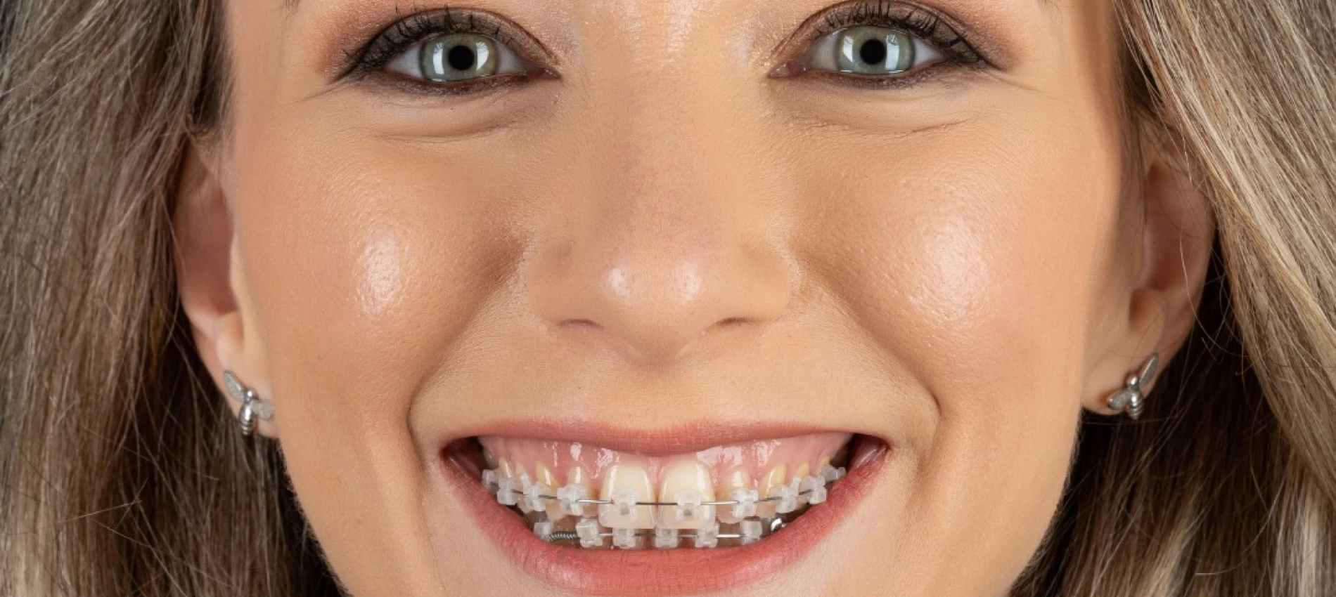 Ortodonție la vârsta adultă: e prea târziu să porți aparat dentar?