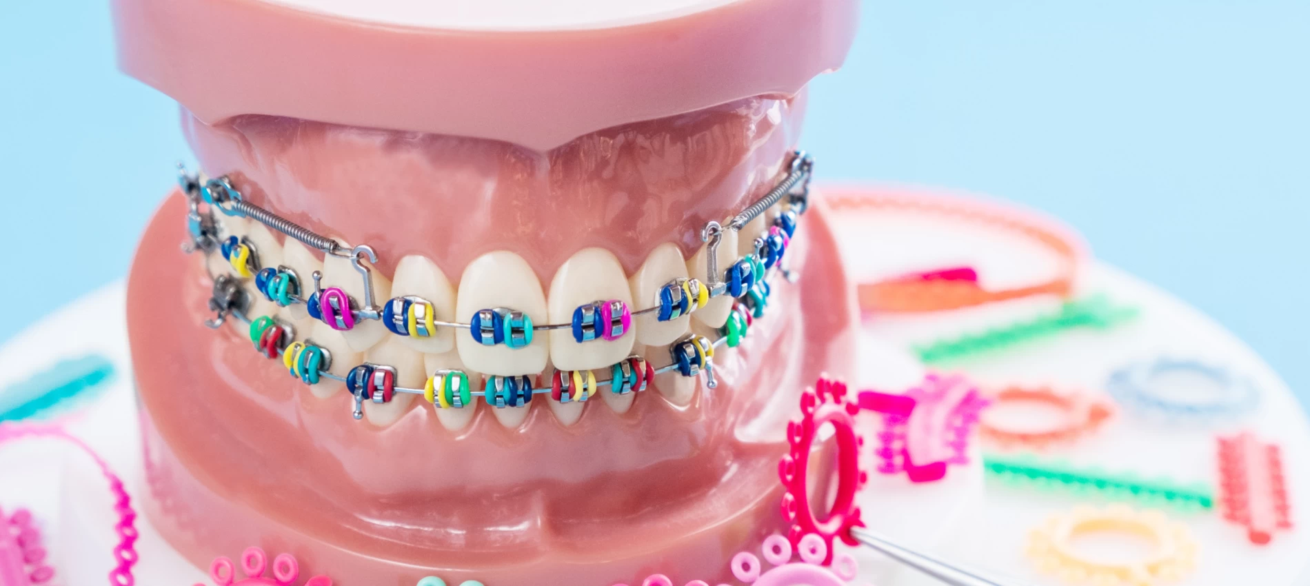 Elasticele aparatului dentar: ce sunt, care este rolul lor și când trebuie înlocuite