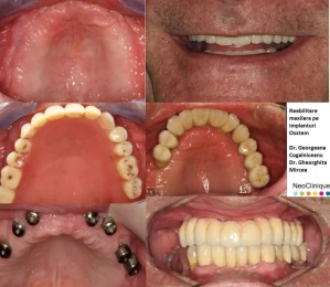 Implant dentar Straumann