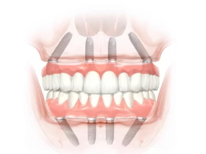 Reabilitarea  danturii  cu  sistemul  de  implanturi  dentare All  on  4 si All  on 6
