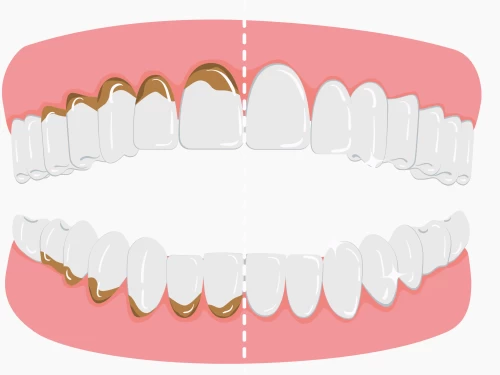 Tartru subgingival