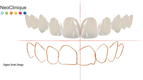 Fatete dentare sau albire ? Afla care dintre ele ti se potriveste cel mai bine