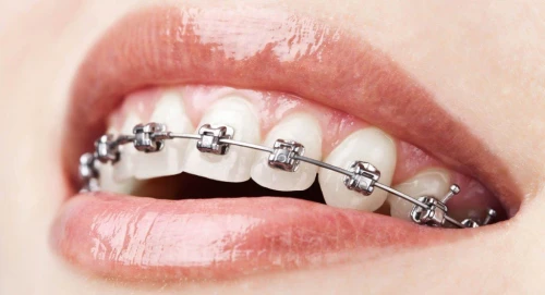 Descoperă totul despre Aparatele Dentare: Beneficii, Tipuri și Procesul de Tratament