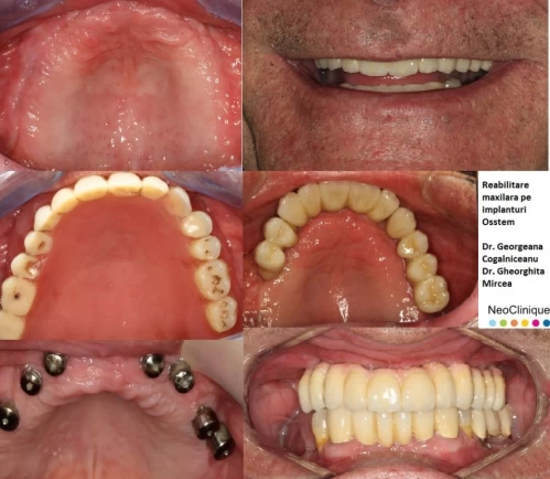 Implant dentar Straumann