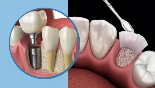 Adiția de os dentar – Ce este, când este necesară și cum decurge procedura