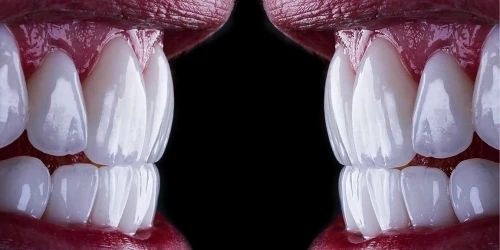 Fatete ceramice versus fatete din compozit