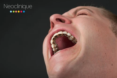 Aparatul dentar lingual Incognito