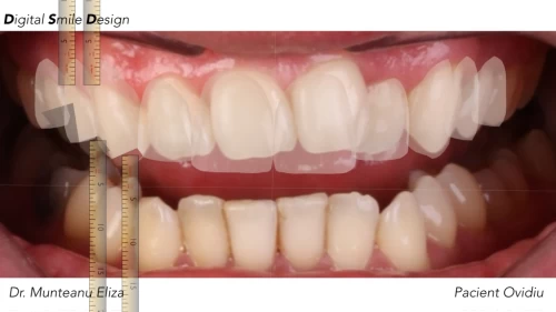 DSD, un trend sau un instrument indispensabil in cabinetul de estetica dentara?