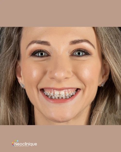 Ortodonție la vârsta adultă: e prea târziu să porți aparat dentar?