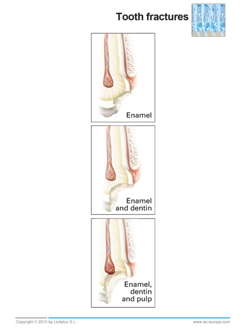 Fractura Dentara