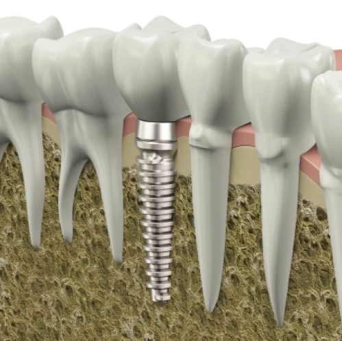 Implantul Dentar si CT-ul