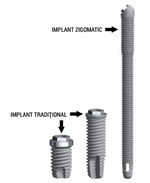 Implantul zigomatic - Solutia reabilitarilor dentare complicate