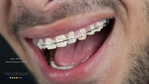 Ce este un aparat ortodontic fix?
