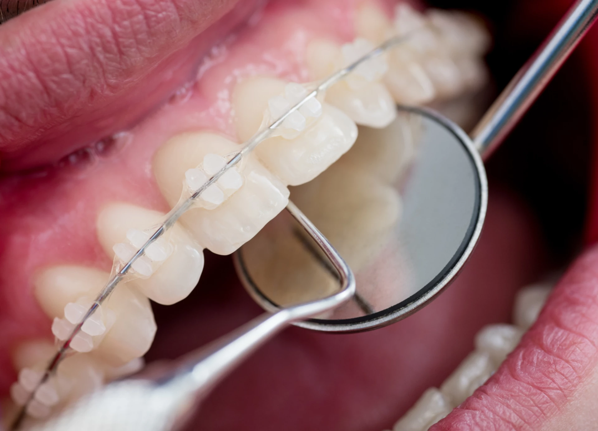 Aparat dentar ceramic