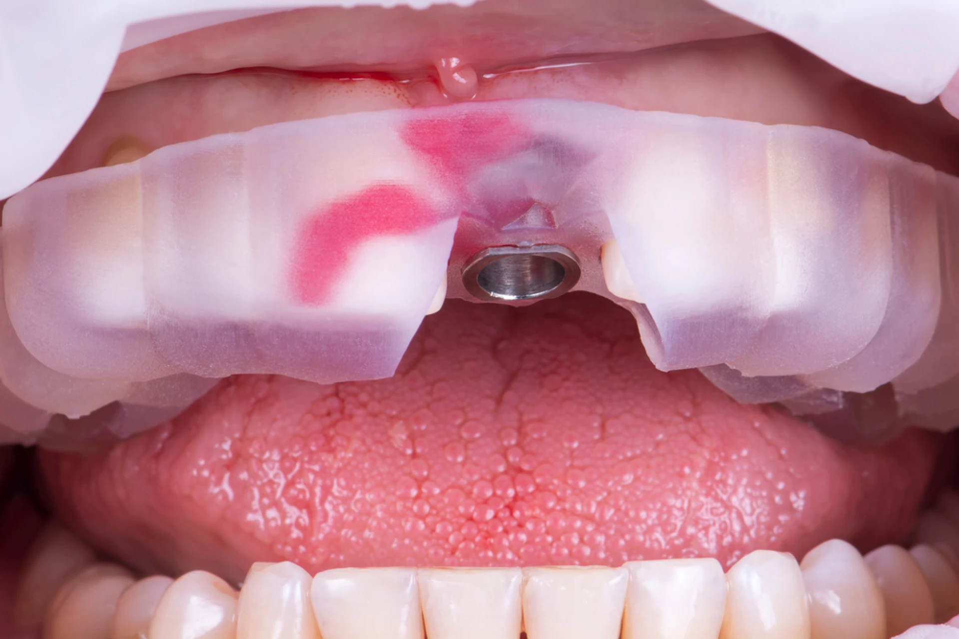 Implant dentar ghidat digital