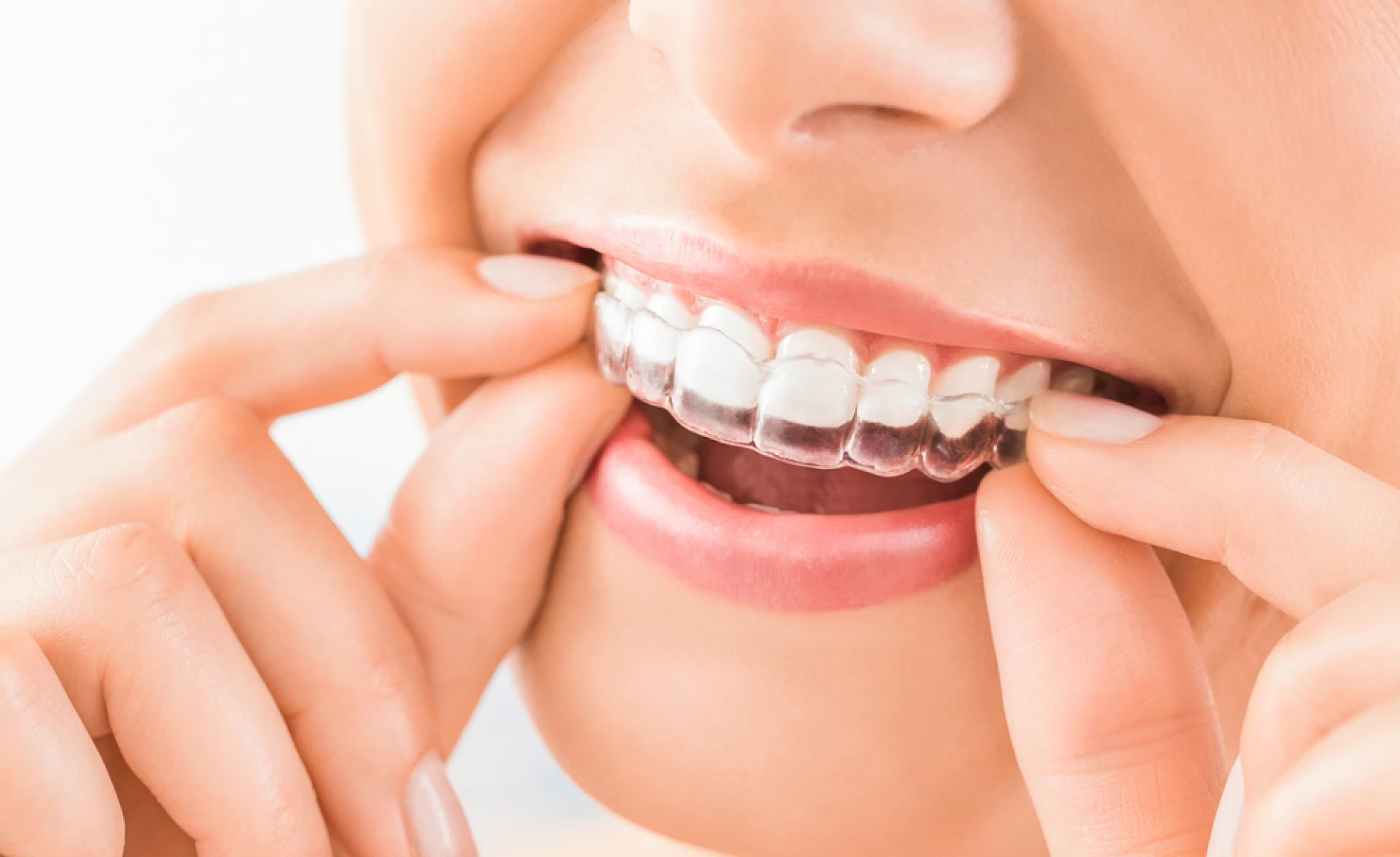 Aparat dentar invizibil tip gutieră