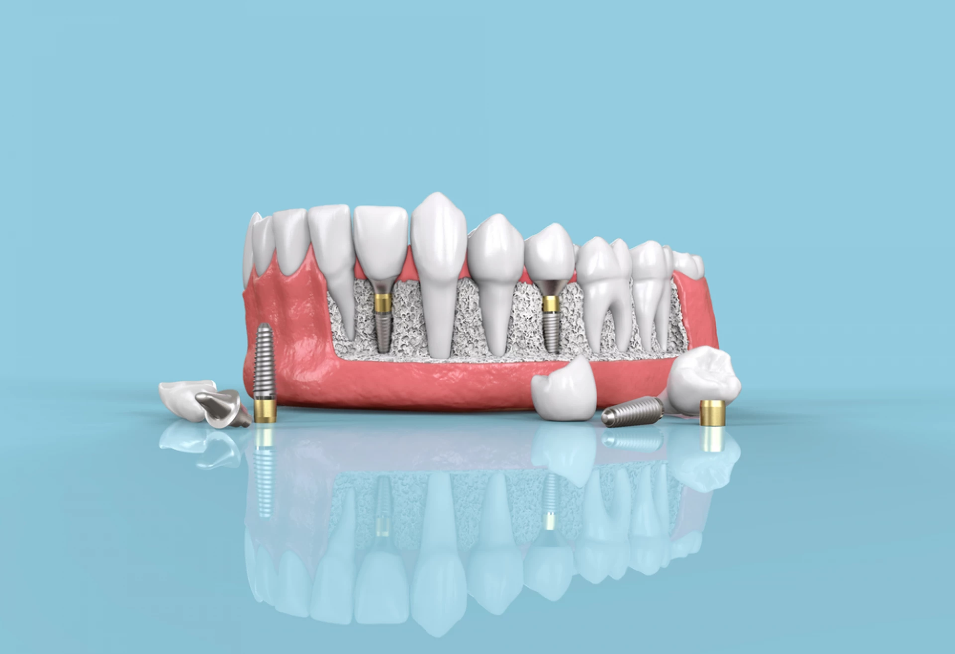 Implant Fast and Fixed