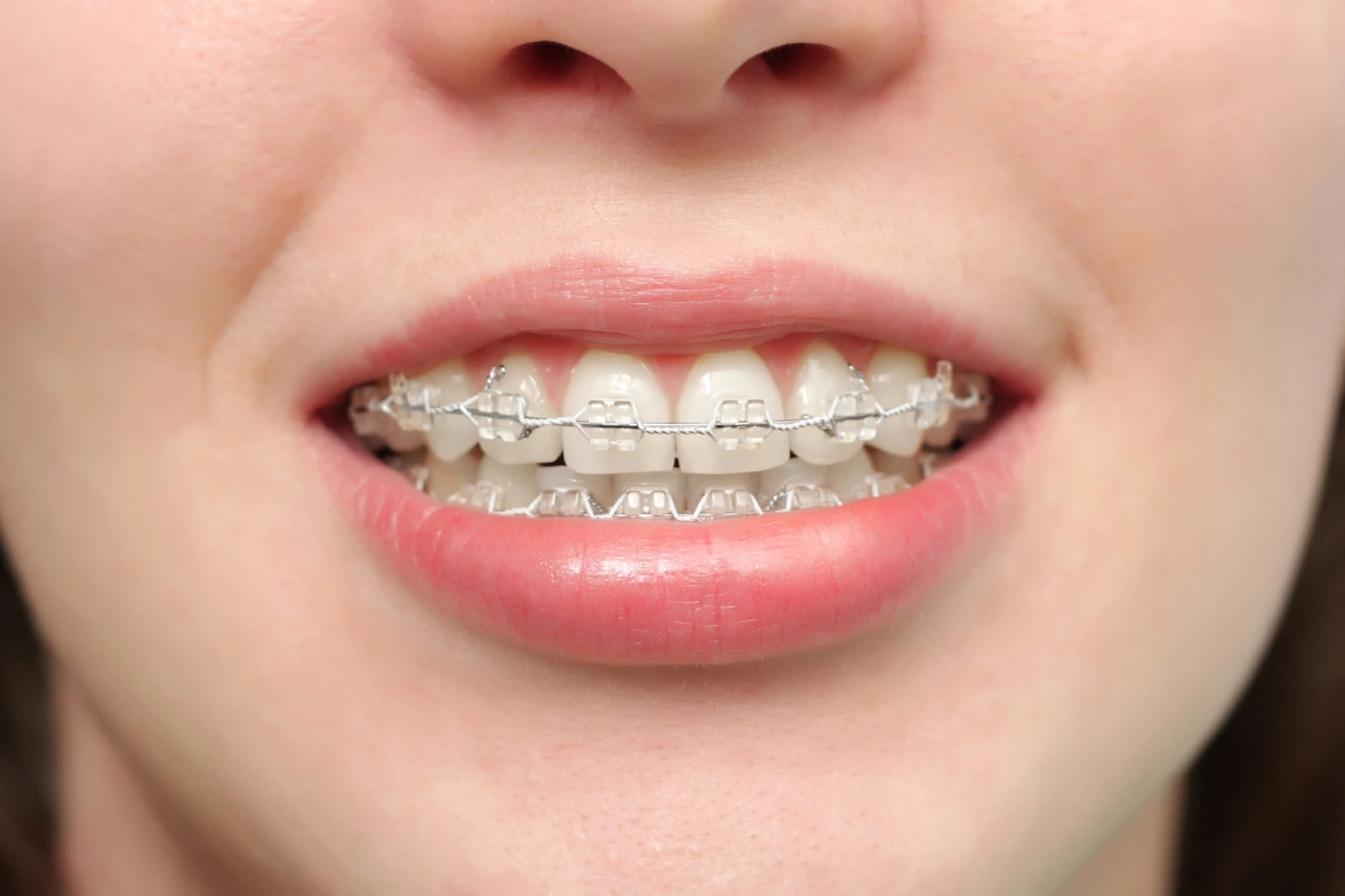 Aparat dentar din safir