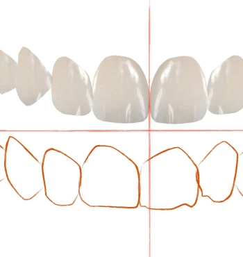 Fatete dentare sau albire ? Afla care dintre ele ti se potriveste cel mai bine