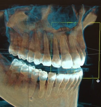 Tomografie dentara 3D