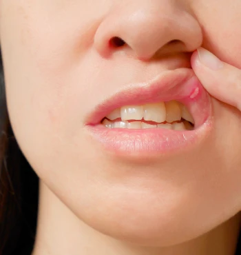 Aftele bucale – cauze, tratamente și prevenție. Cum scăpăm eficient de ele