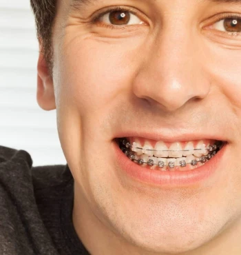 Aparat dentar fix
