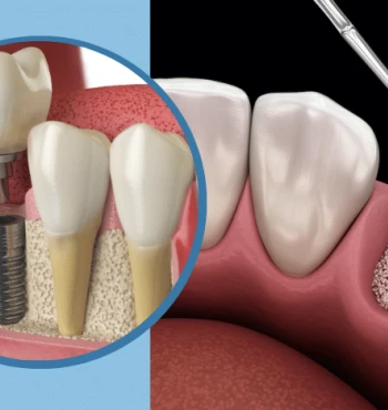 Adiția de os dentar – Ce este, când este necesară și cum decurge procedura