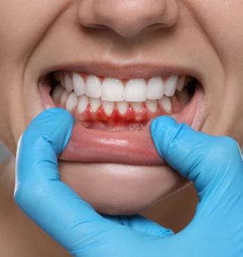 Gingii retrase? Cauze frecvente și opțiuni corecte de tratament