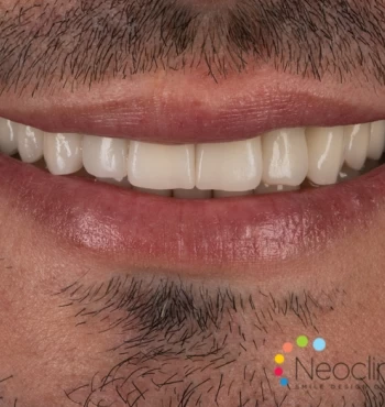 Mit si adevar despre fatetele dentare