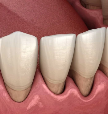 Retragerea gingivală