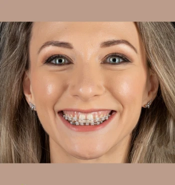 Ortodonție la vârsta adultă: e prea târziu să porți aparat dentar?