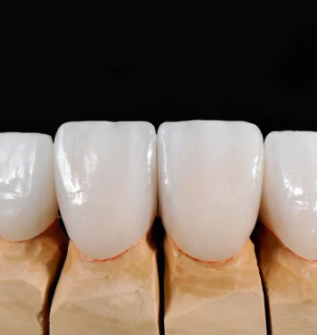 Tot ce trebuie sa stii despre fatete dentare
