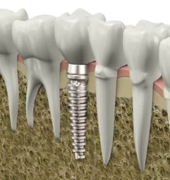 Implantul Dentar si CT-ul