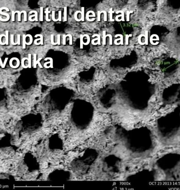 ALCOOLUL ITI AFECTEAZA DINTII?