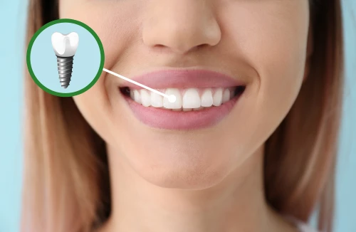 Implantologie dentară