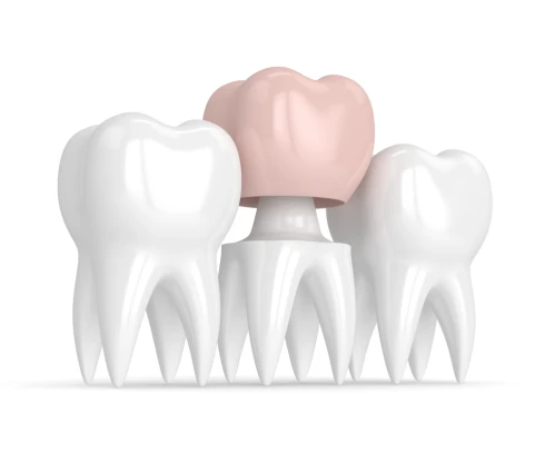 Coroane dentare